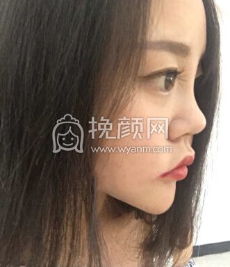 武汉卓美医院王海平教授给做的鼻部手术