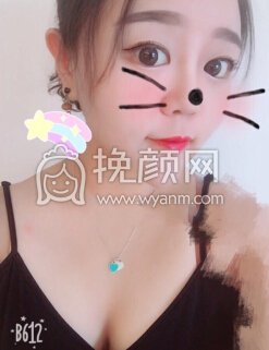 武汉卓美医院王海平教授给做的鼻部手术