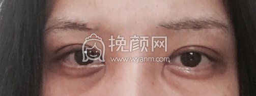 厦门中医院卢医生全切双眼皮+提肌+内眼角