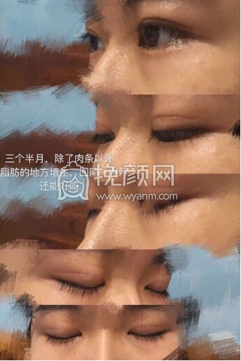 双眼皮三个半月了,小切口微创有肉条
