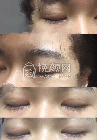 双眼皮三个半月了,小切口微创有肉条
