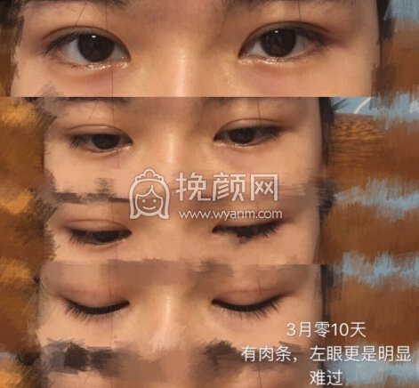 双眼皮三个半月了,小切口微创有肉条