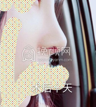 东莞美立方向宏伟医生半肋膨体鼻部手术手术