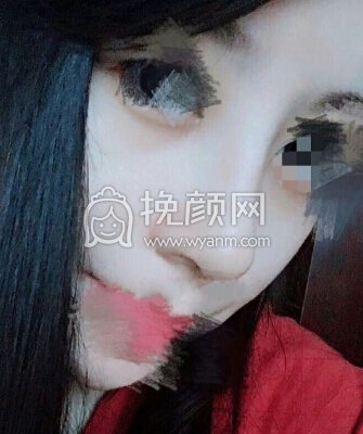 东莞美立方向宏伟医生半肋膨体鼻部手术手术