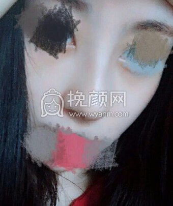 东莞美立方向宏伟医生半肋膨体鼻部手术手术