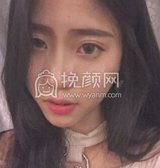 上海喜美徐文龙医生做的鼻部手术