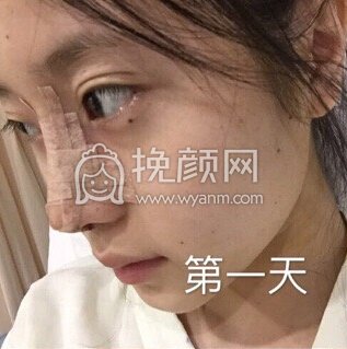上海喜美徐文龙医生做的鼻部手术