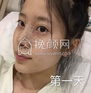 上海喜美徐文龙医生做的鼻部手术