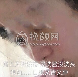 上海喜美徐文龙医生做的鼻部手术