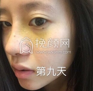上海喜美徐文龙医生做的鼻部手术