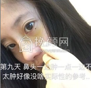 上海喜美徐文龙医生做的鼻部手术