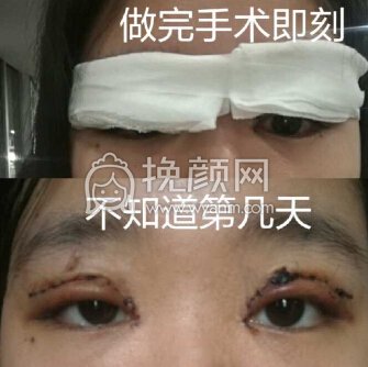 厦门大学附属第一医院樊树强全切+开眼角