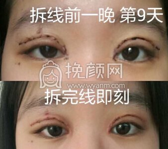 厦门大学附属第一医院樊树强全切+开眼角