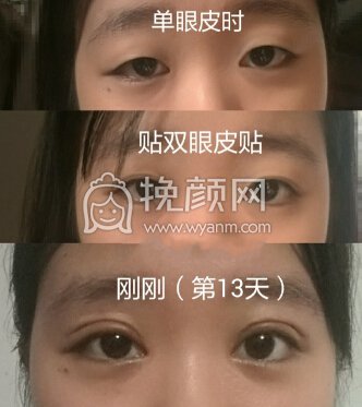 厦门大学附属第一医院樊树强全切+开眼角