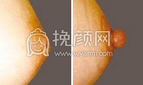 乳头内陷的手术调节