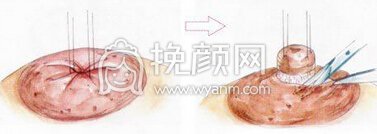 乳头内陷的手术调节