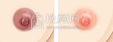 乳晕色彩深怎么让乳晕变红
