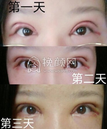 郑州第三附属医院张鹏全切双眼皮+开内眼角