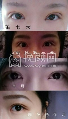 郑州第三附属医院张鹏全切双眼皮+开内眼角