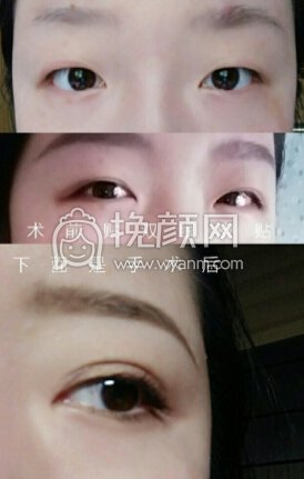 郑州第三附属医院张鹏全切双眼皮+开内眼角