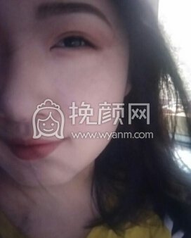 郑州第三附属医院张鹏全切双眼皮+开内眼角