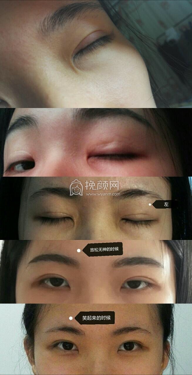 闭眼双和肉条,左眼闭眼双很严重