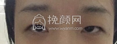 深圳美莱医院陈磊医生做的全切双眼皮+提肌