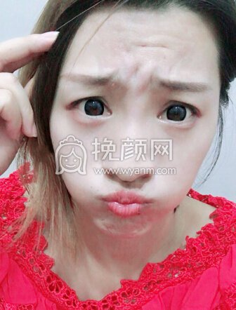 小姐姐分享的打注射瘦脸感受