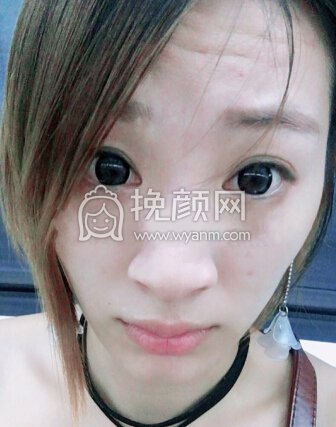小姐姐分享的打注射瘦脸感受