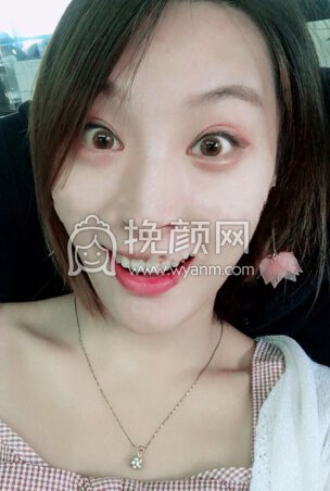 小姐姐分享的打注射瘦脸感受