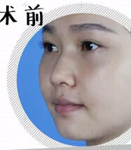 做个隆鼻之后到底会发生怎样的改变?