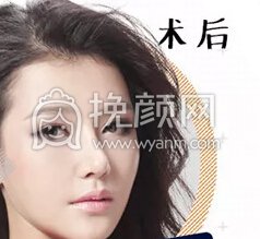 做个隆鼻之后到底会发生怎样的改变?