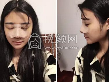 瑞芙臣隆鼻手术恢复全过程...