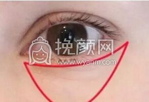 你的眼袋是哪种,该怎么治?