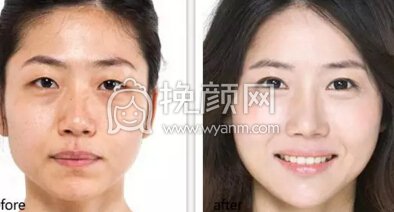 你的眼袋是哪种,该怎么治?