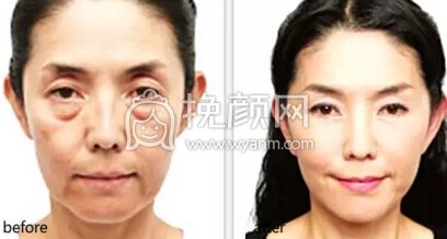 你的眼袋是哪种,该怎么治?