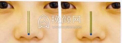 隆鼻操作过程分享