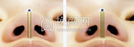 隆鼻操作过程分享