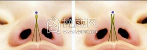 隆鼻操作过程分享