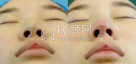 隆鼻操作过程分享