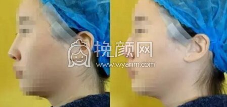 隆鼻操作过程分享