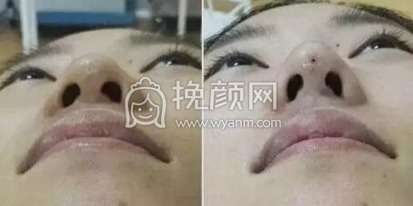 隆鼻操作过程分享