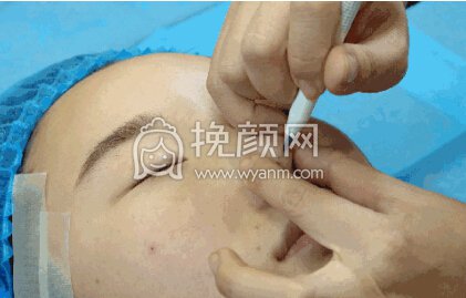 隆鼻操作过程分享