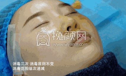 隆鼻操作过程分享