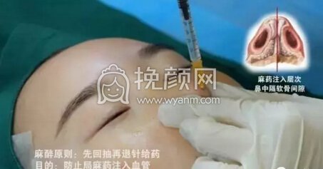 隆鼻操作过程分享