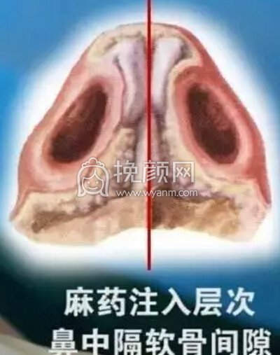 隆鼻操作过程分享