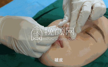 隆鼻操作过程分享