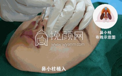 隆鼻操作过程分享