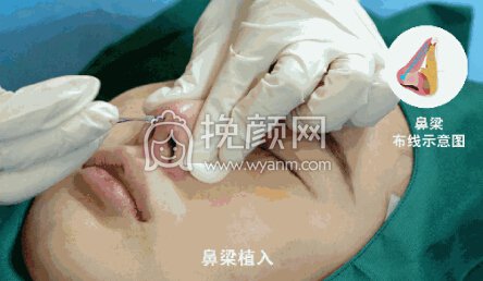 隆鼻操作过程分享