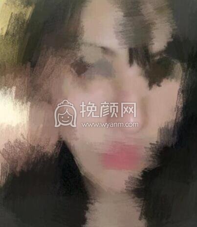 苏州薇琳曹院长做的鼻部手术